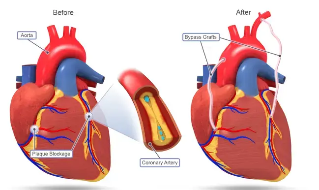 CABG Explained in detail